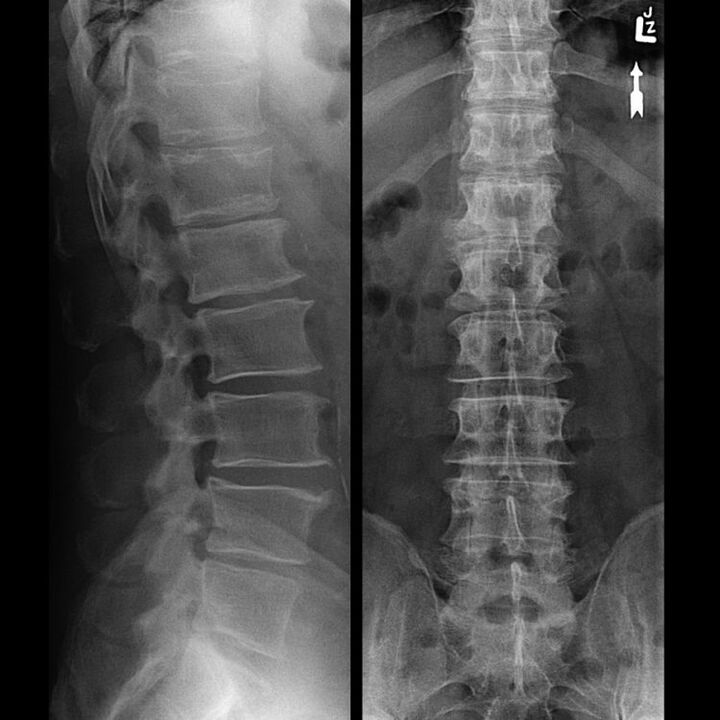 Lülisamba nuusutamine osteokondroosiga